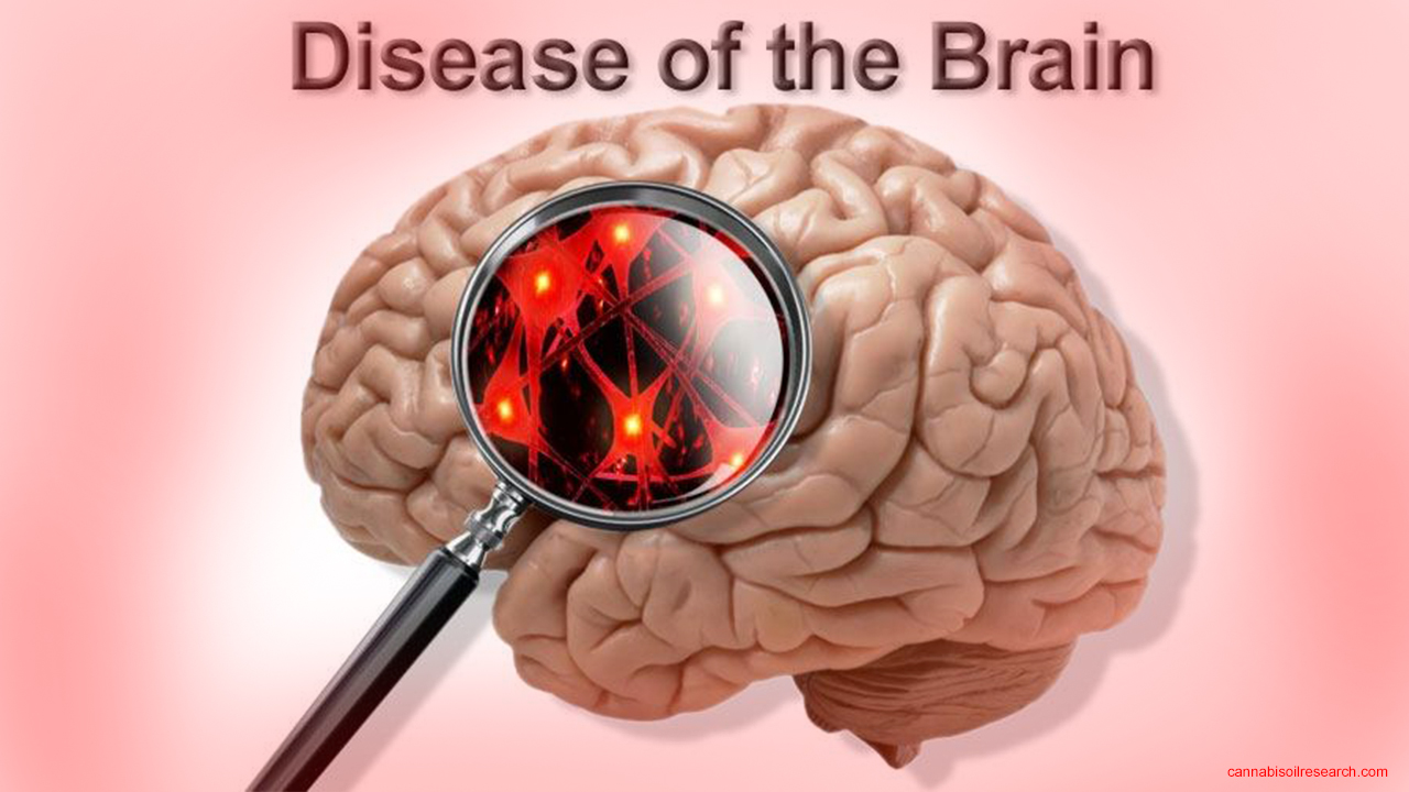 Brain diseases. Мозг больного Аспергером.