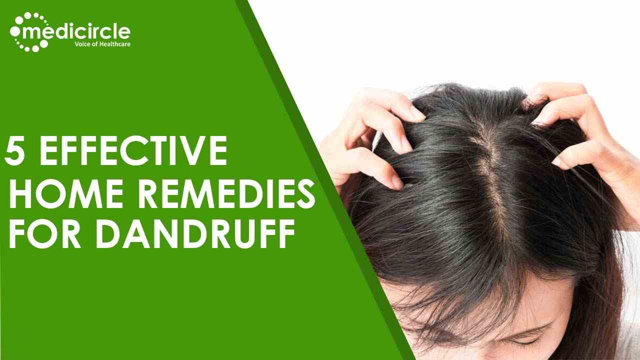 5 Effective natural home remedies for dandruff