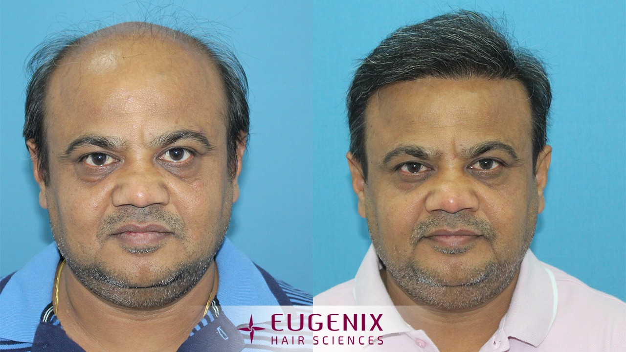 Eugenix Hair Sciences and hair transplantation in India