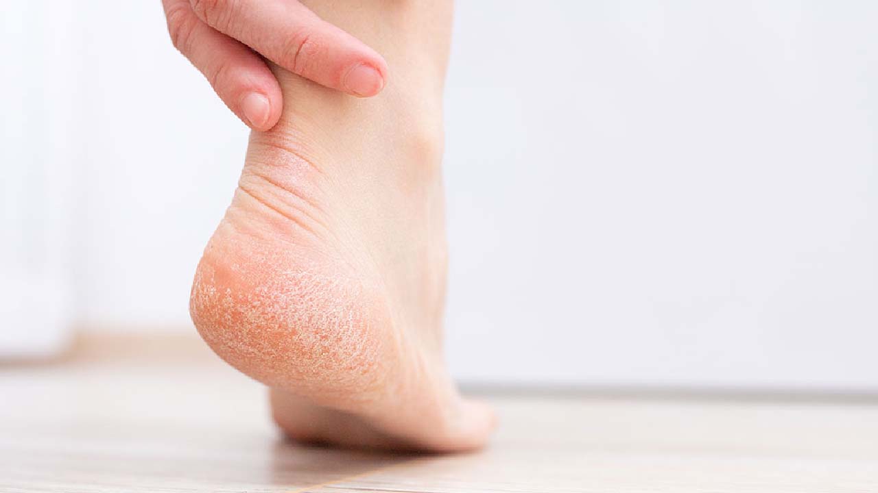 Say Goodbye to Cracked Heels in Just 5 Minutes