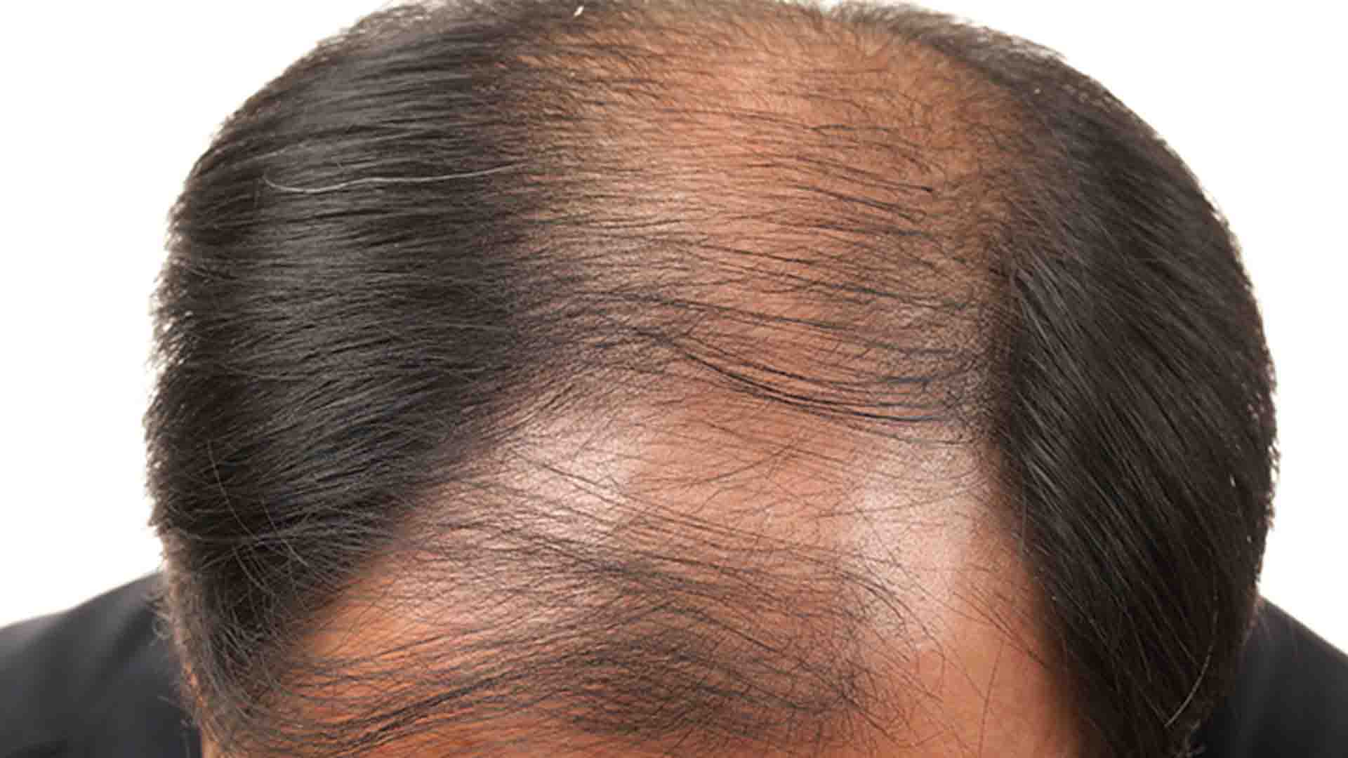 Causes Symptoms And Treatment For Male Pattern Baldness