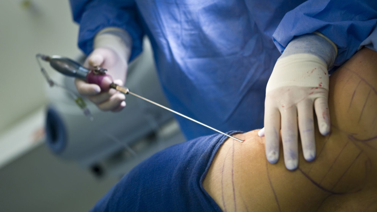 Is Liposuction surgery safe? Know the side effects of Liposuction Surgery